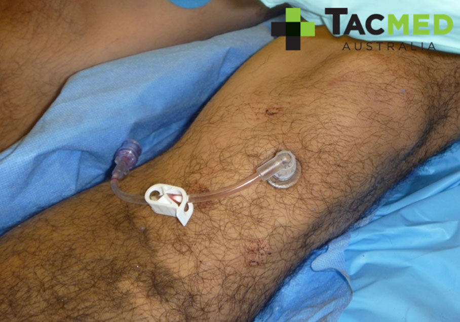 Shredded intestines from a gunshot wound to the leg!