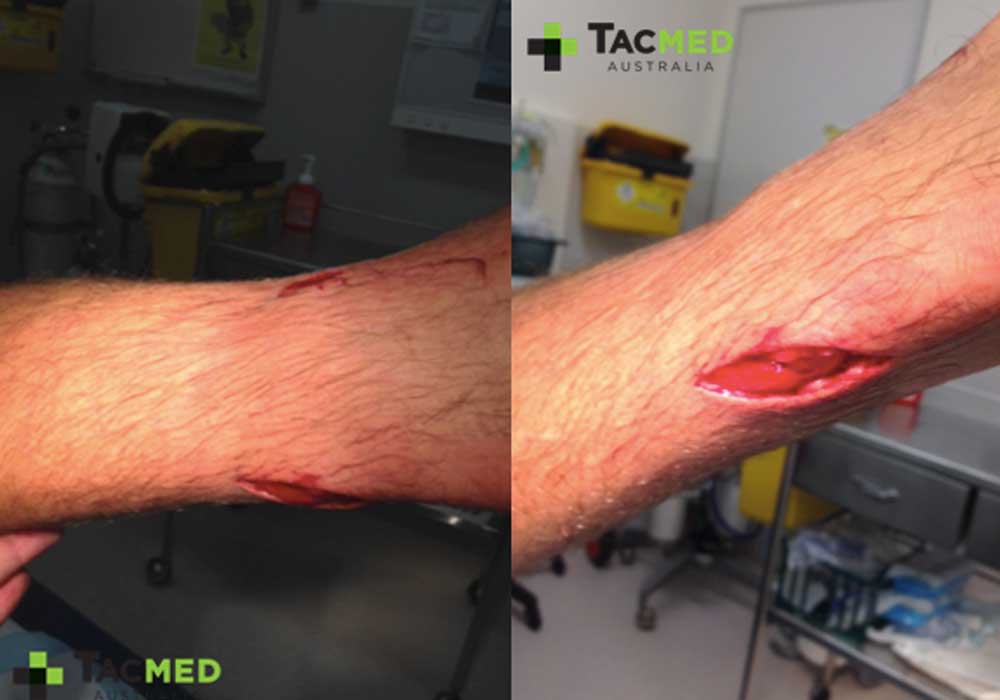 Spear wound to the leg whilst pig hunting!