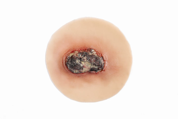 TraumaSim Malignancy - Fungating