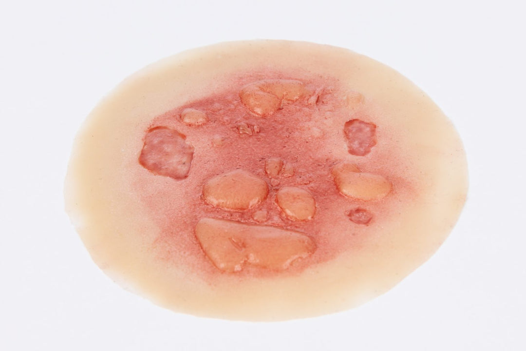 TraumaSim Burn Blistered