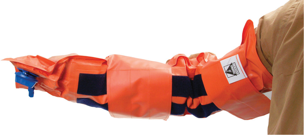 Vacuum splint applied to patient's arm for immobilisation

