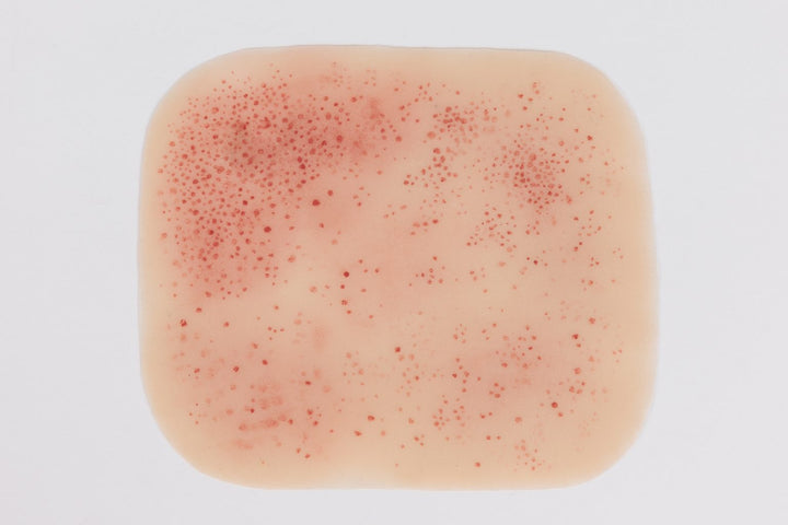 TraumaSim Rash - Meningococcal
