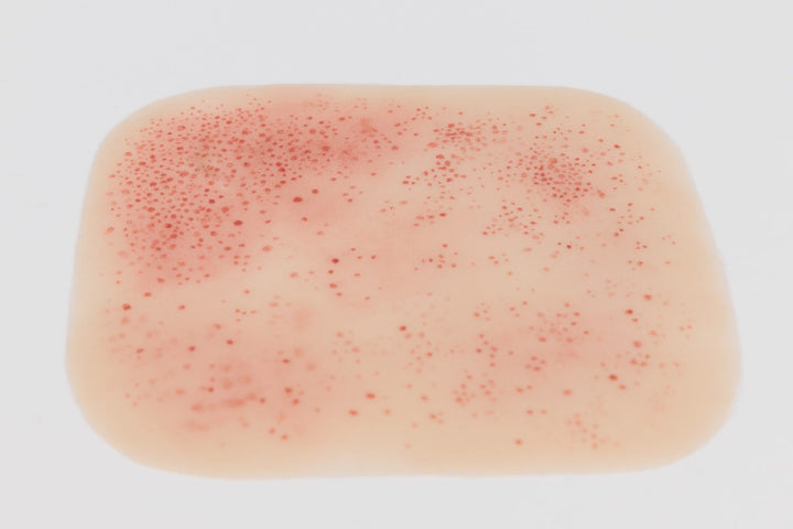 TraumaSim Rash - Meningococcal