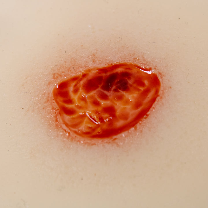 TraumaSim Ulcer - Small