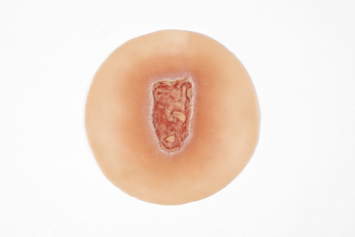 TraumaSim Ulcer - Leg Mixed