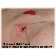 Full-sized Hyfin ent used in image to demonstrate placement on a penetrating chest wound
